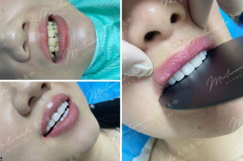 牙贴面对比明星网红,效果对比，谁更胜一筹？