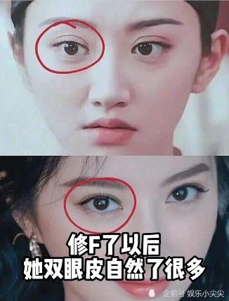 明星网红整容前后分析,美丽蜕变背后的秘密解析